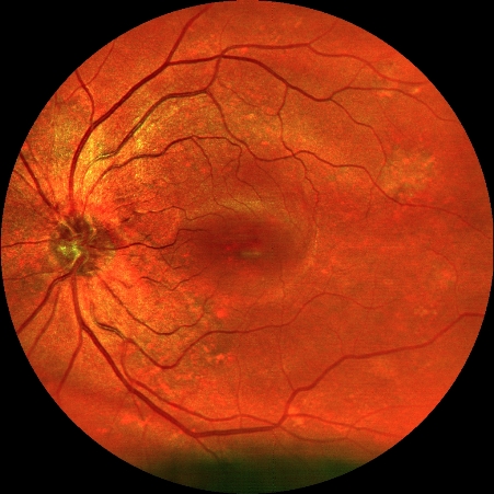 hochauflösendes Netzhautbild Easyscan